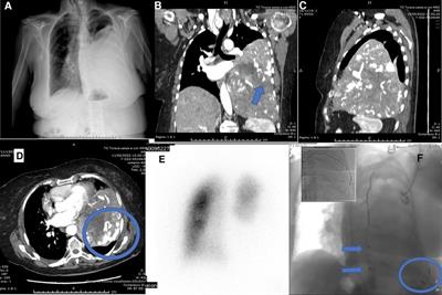 Case report: A giant lung leiomyosarcoma: From an accurate diagnosis to a successful surgery. A rare case and brief literature review